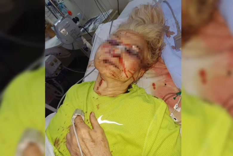 Idosa de 77 anos é agredida por homem em situação de rua na Asa Norte e sofre fraturas no rosto