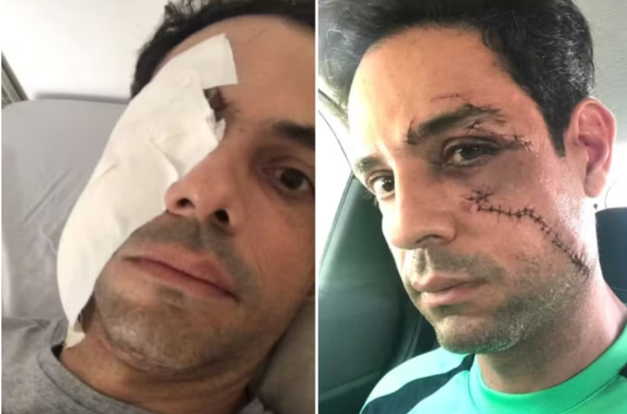 Empresário leva 62 pontos no rosto após ser agredido com copo de vidro em festa em Fortaleza
