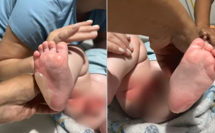 Bebê tem 29% do corpo queimado durante banho em berçário em Rio Verde