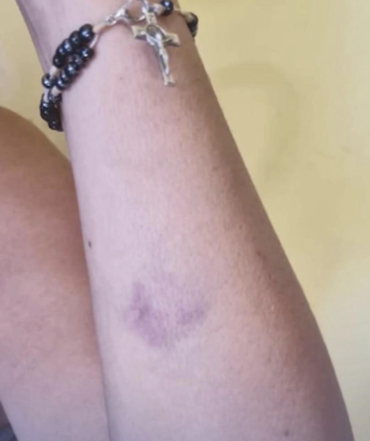 Marcas de violência no braço da vítima